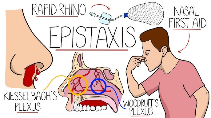epistaxis icd 10