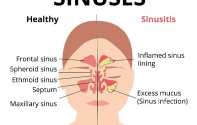 Sinusitis ICD 10
