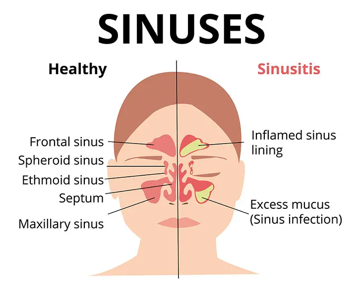 Sinusitis ICD 10