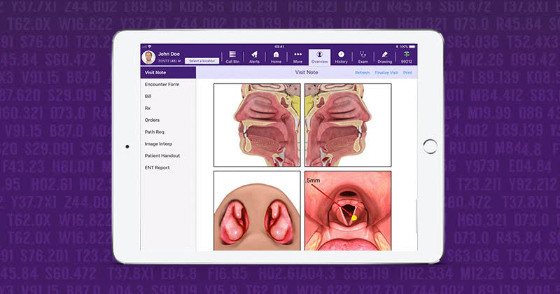 Epistaxis ICD 10