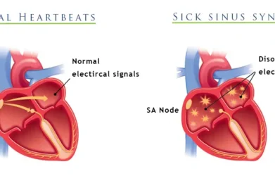 Sick Sinus Syndrome ICD 10