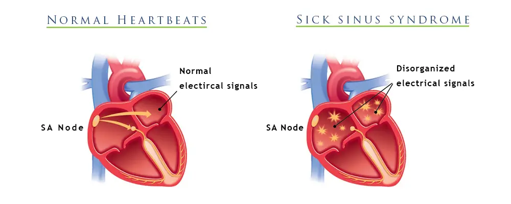 Sick Sinus Syndrome ICD 10