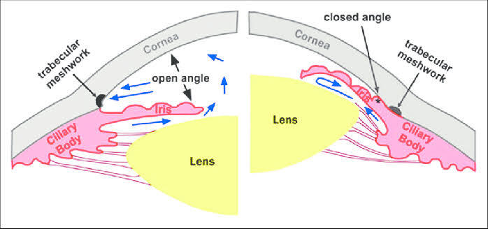 Glaucoma ICD 10