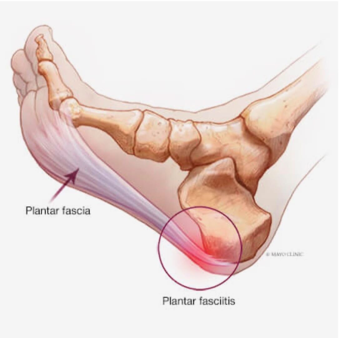Plantar Fasciitis ICD-10
